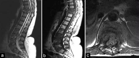 A B T W And T W Sagittal Mri Of Dorsolumbar Spine Showing