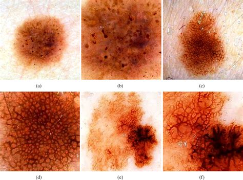 Figure 2 1 From Towards Prevention And Early Diagnosis Of Skin Cancer