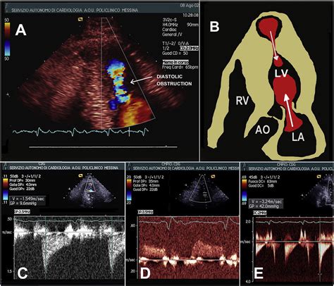 Progression Rates Of Apical Aneurysm And Dynamic Obstruction In Mid Ventricular Hypertrophic