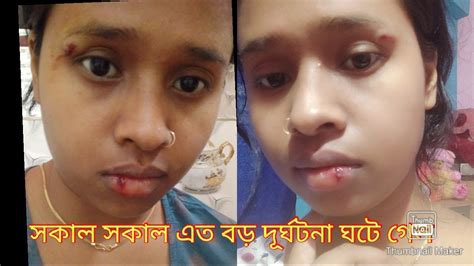 সকাল সকাল এত বড় দূর্ঘটনা ঘটে গেল আমার সাথে 😭😭 Youtube