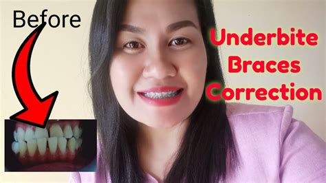 My Underbite Braces Journey Youtube