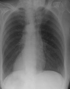 Situs inversus Totalis, Solitus-Complications, Causes