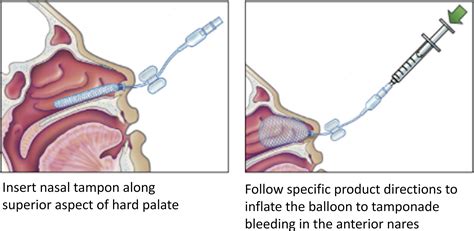 Epistaxis Emergency Medicine Clinics