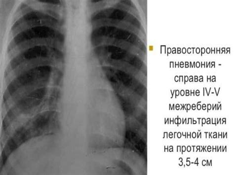 Пневмония у детей - презентация онлайн