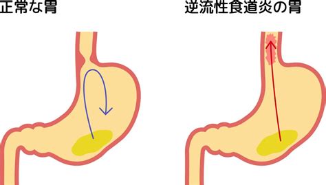 逆流性食道炎を引き起こす3つ原因を解説｜堺市いたわり健康院 さかい快福整体堂｜堺市いたわり健康院 さかい快福整体堂のプレスリリース