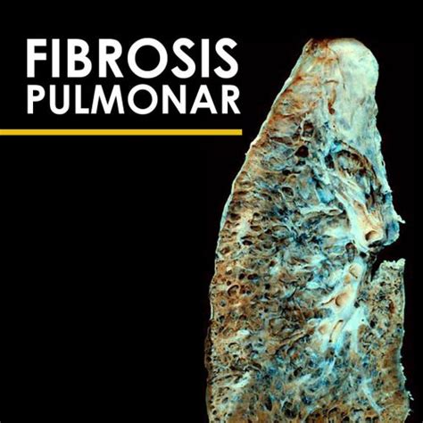 Asbestosis fibrosis pulmonar causas idiopática diagnóstico