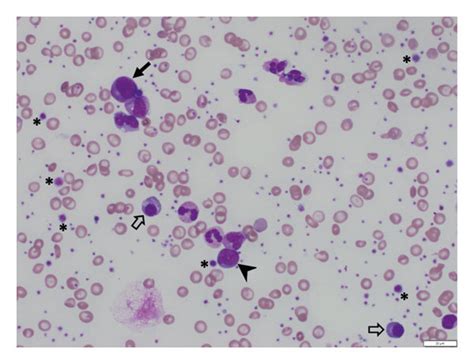 Peripheral Blood Smear Wrightgiemsa Stain 50x Magnification Showing