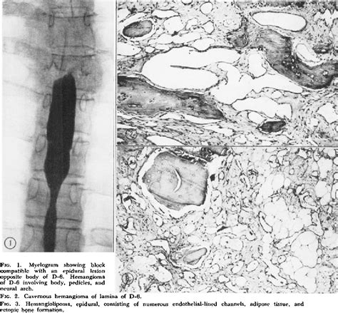 Figure 1 From Spinal Epidural In Hemangioma In Pregnancy Semantic Scholar