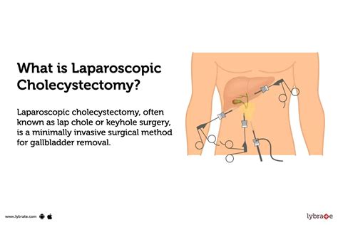 Laparoscopic Cholecystectomy