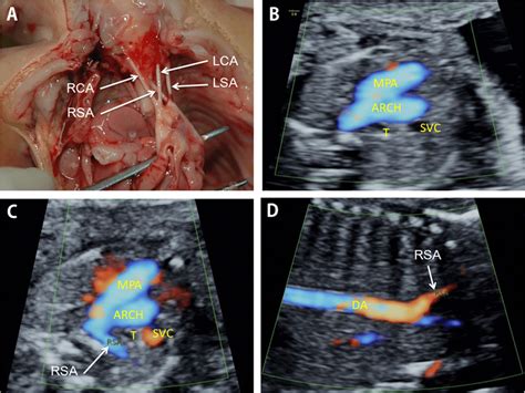 Inspection Of Fetal Aberrant Right Subclavian Artery A Anatomical