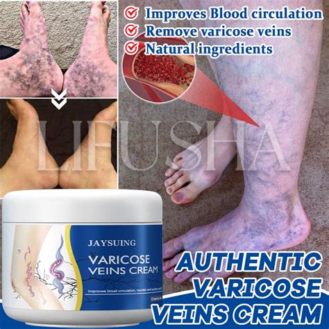 Varicose Vein Remover Spider Vein Pain Relief Cream Original Effective