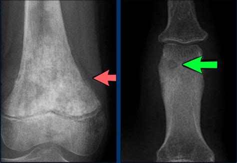 Osteosarcoma X Ray