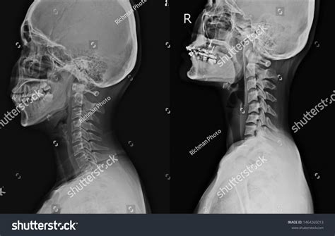 Cervical Spine Xray