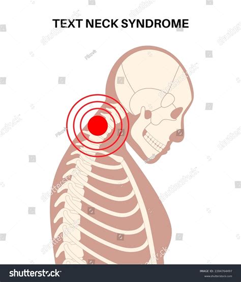 Diagram Deformation Cervical Vertebrae Neck Spasm Stock Vector Royalty