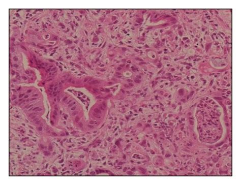 ((a)–(c)) Photomicroscopy images showing lipoleiomyoma infiltrated with ...