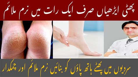 Crack Heels Home Remedy Cream In 3 Days Reduce Cracked Heels