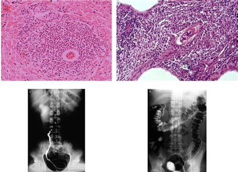 Diagnosis And Management Of Schistosomiasis The Bmj