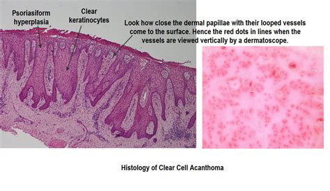 Dermoscopy Made Simple: Clear Cell Acanthoma