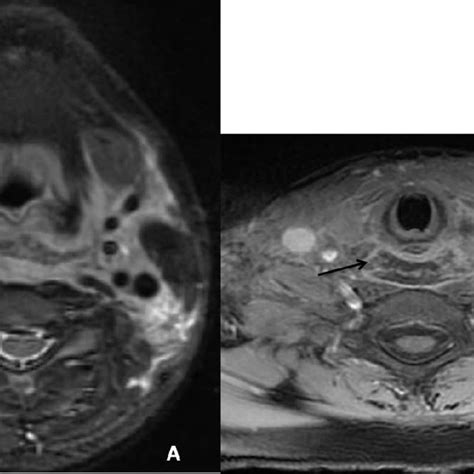 Magnetic Resonance Imaging A Space Occupying Lesion Exhibiting Diffuse