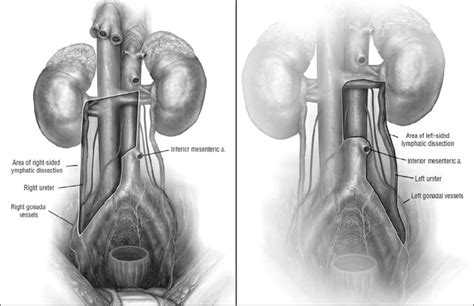 Right And Left Sided Templates From Wood Cg Retroperitoneal Lymph Download Scientific Diagram