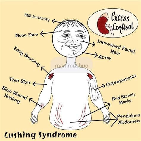 Cushing Syndrome Cushings Syndrome Syndrome Cushing