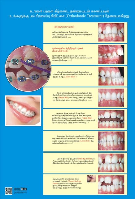 Common dental problems requiring orthodontic treatment (Tamil) DP-15-T ...