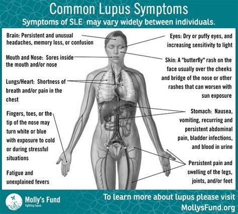 What are the signs and symptoms of Lupus?