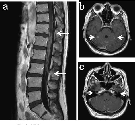 Figure 2 From A Case Of Poorly Differentiated Rectal Adenocarcinoma Causing Meningeal