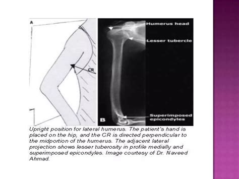 Radiographic positioning of humerus and shoulder | PPTX