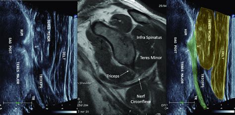 Sagittal view of the triceps tendon with MRI correlation. HUM: Humerus,... | Download Scientific ...