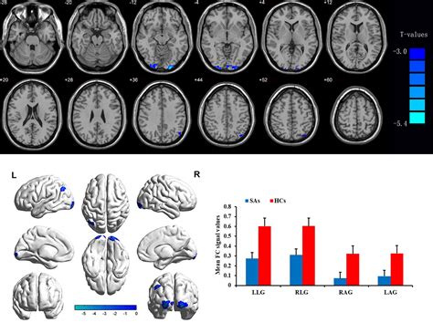 Altered Functional Connectivity Of Primary Visual Cortex In Adults With