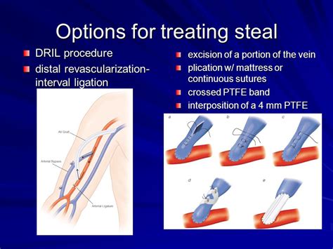 Vascular Access Complications During Dialysis Ii Ppt Video Online