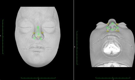 Effect Of Maxillary Alveolar Reconstruction On Nasal Symmetry Of Cleft