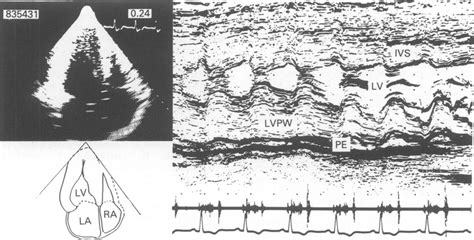 Apical Four Chamber View Of The Two Dimensional And M Mode