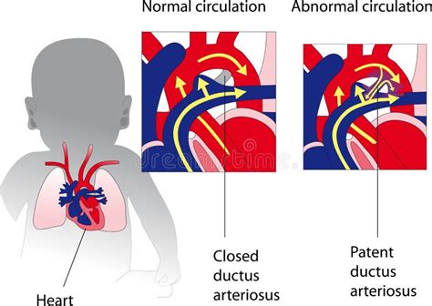 Patent Ductus Arteriosus With Normal Heart Anatomy Illustration Of The