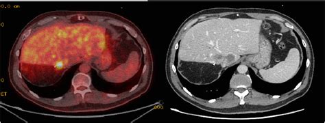 Stereotactic Body Radiation Therapy And Central Liver Toxicity A Case