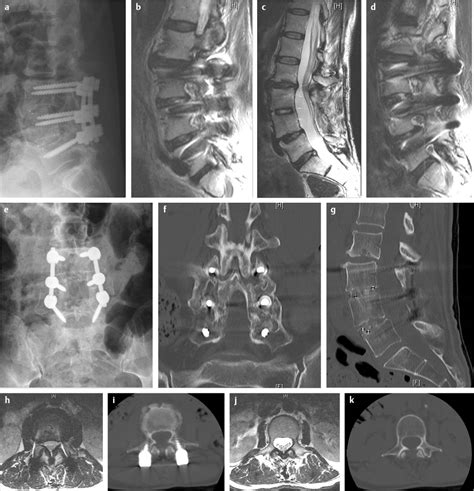 Is Lumbar Adjacent Segment Degeneration Best Treated Using Minimally Invasive Surgery Over Open