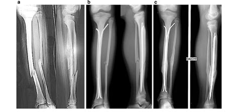 Tibia fracture treated by ESIN, a displaced shaft fracture of fibula... | Download Scientific ...