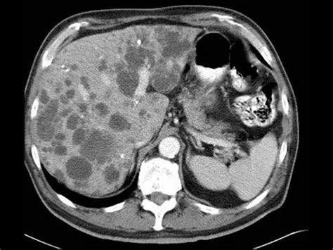 Abdomen And Retroperitoneum 1 1 Liver Case 1 1 4 Liver Cysts