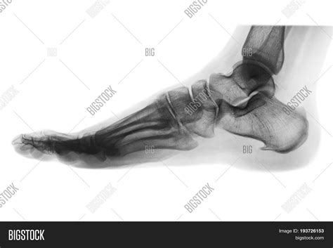 X Ray Normal Human Image And Photo Free Trial Bigstock