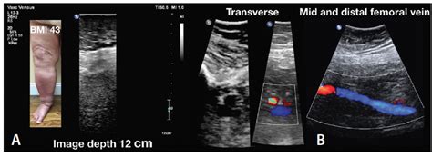 Lower Extremity Ultrasound Anatomy Porn Sex Picture