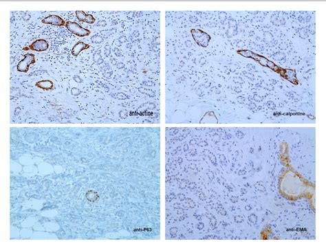 Figure 3 From [diagnostic Pitfalls In Mammary Pathology Case 4 Microglandular Adenosis