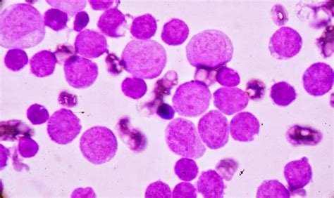 Causes and Treatment of Low Lymphocyte Count [Lymphocytopenia]