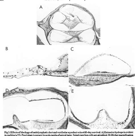 Figure 1 From Degeneration Of Vestibular Sensory Cells Caused By