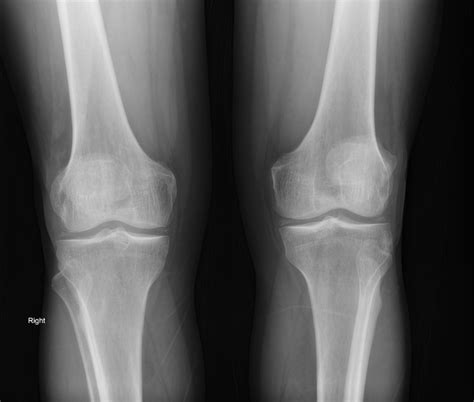 Chondrocalcinosis Radiology Reference Article Radiopaedia Org