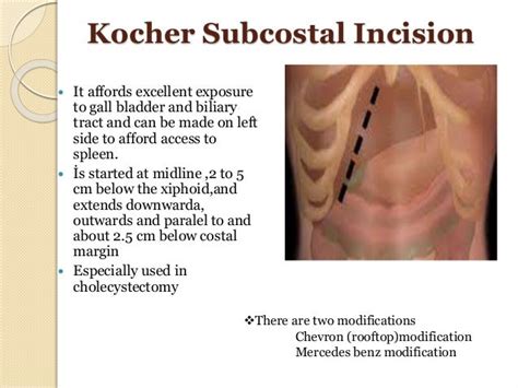 Abdominal Incisions