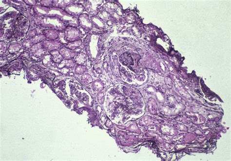 Ajkd Atlas Of Renal Pathology Focal And Diffuse Lupus Nephritis Isn