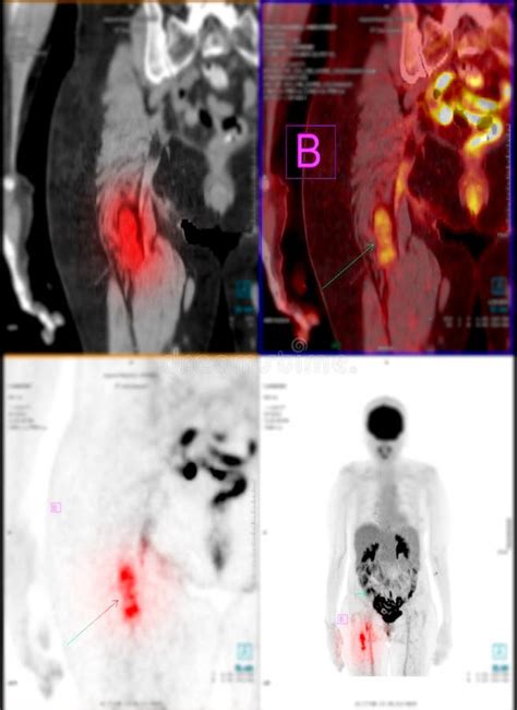 Positron Emission Tomography Pet Ct Scan Of Whole Human Body Stock