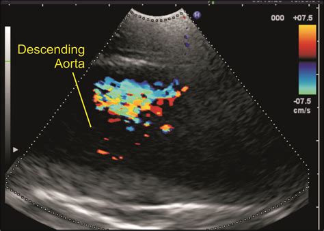 Techniques Of Linear Endobronchial Ultrasound Intechopen