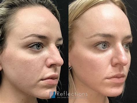Fraxel Dual Laser Resurfacing Ph